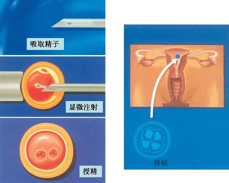 广州助孕机构;星韫告诉您现在做试管婴儿的夫妻越来越多的原因