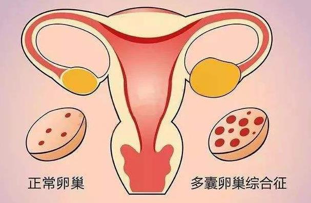 多囊患者做试管婴儿要注意什么?多囊患者可以做试管吗?